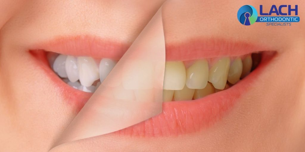 Teeth Whitening Lake Nona