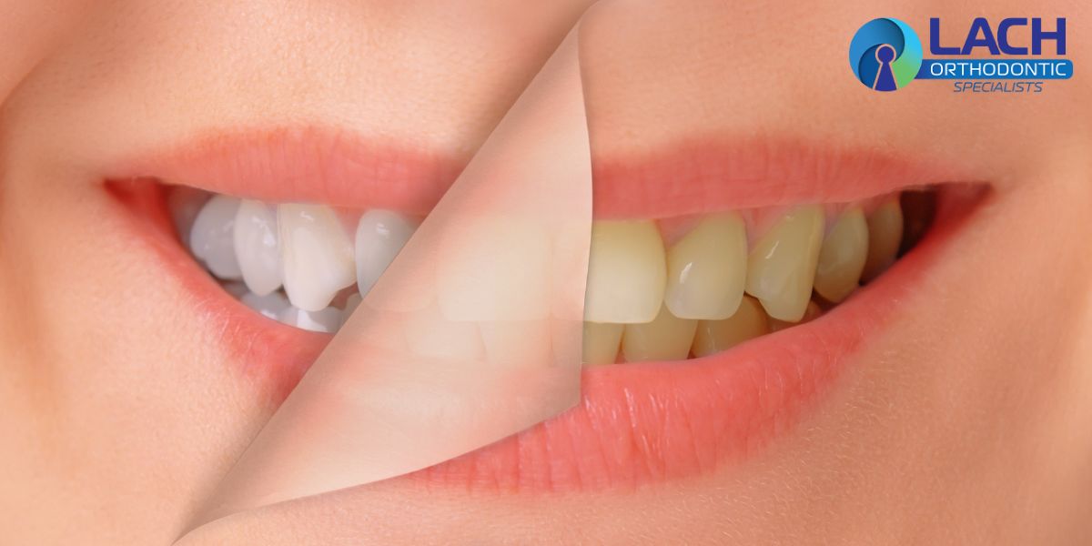 Blog 7 Orthodontics Teeth whitening lake nona