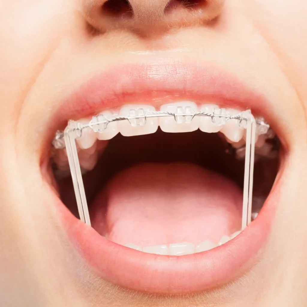 Braces vs lingual braces cost (5)