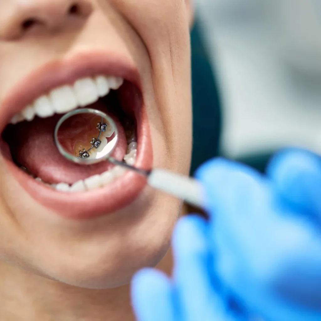 Braces vs lingual braces cost (6)