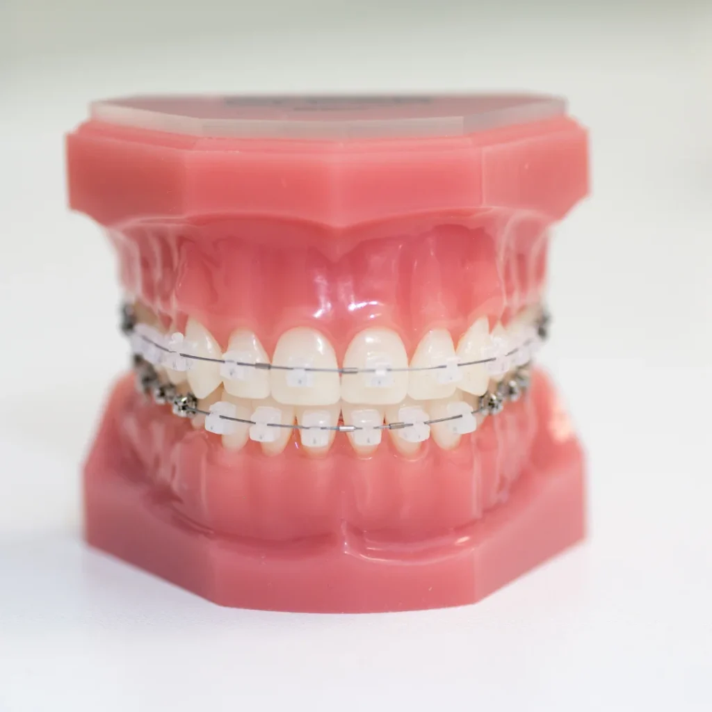Braces vs lingual braces cost