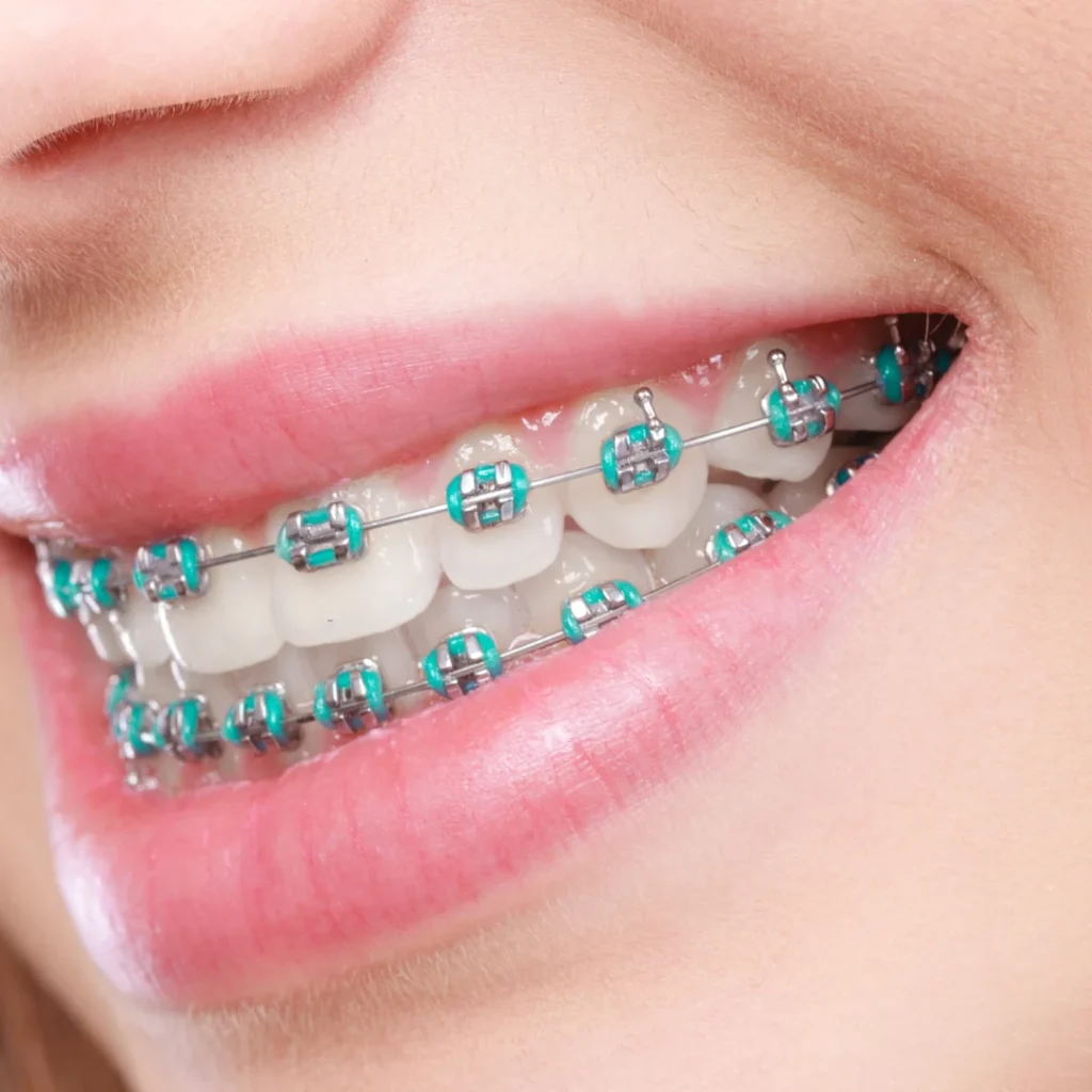 Color braces for teeth at lach orthodontic specialists (1)