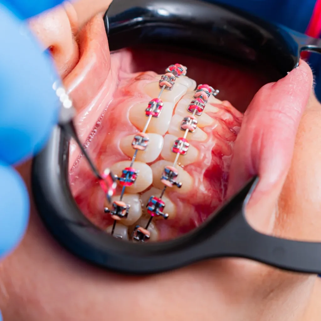 Color braces for teeth at lach orthodontic specialists