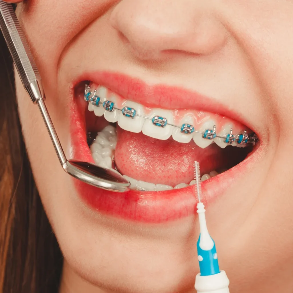 Color braces for teeth at lach orthodontic specialists (2)