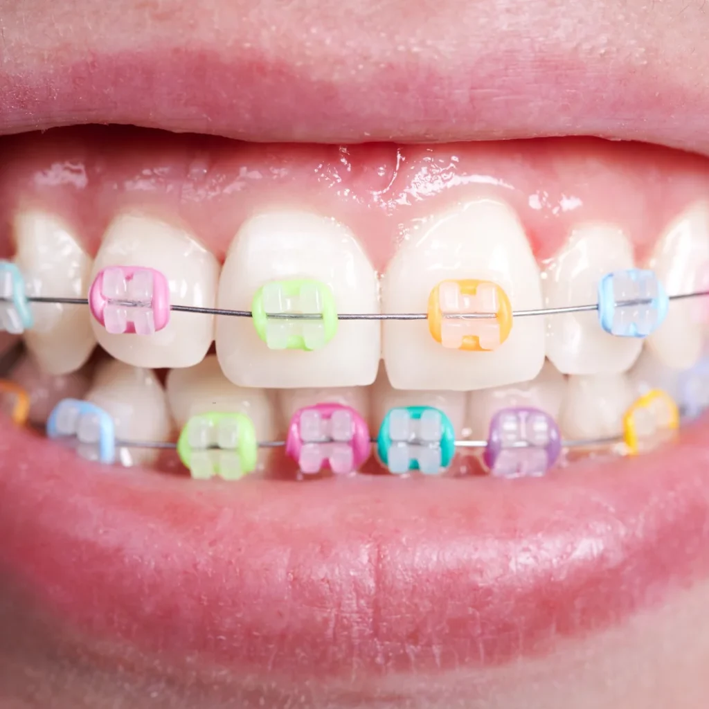 Color braces for teeth at lach orthodontic specialists (3)
