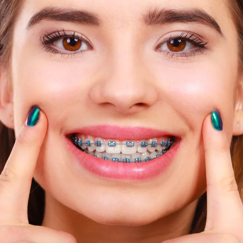 Color braces for teeth at lach orthodontic specialists (4)