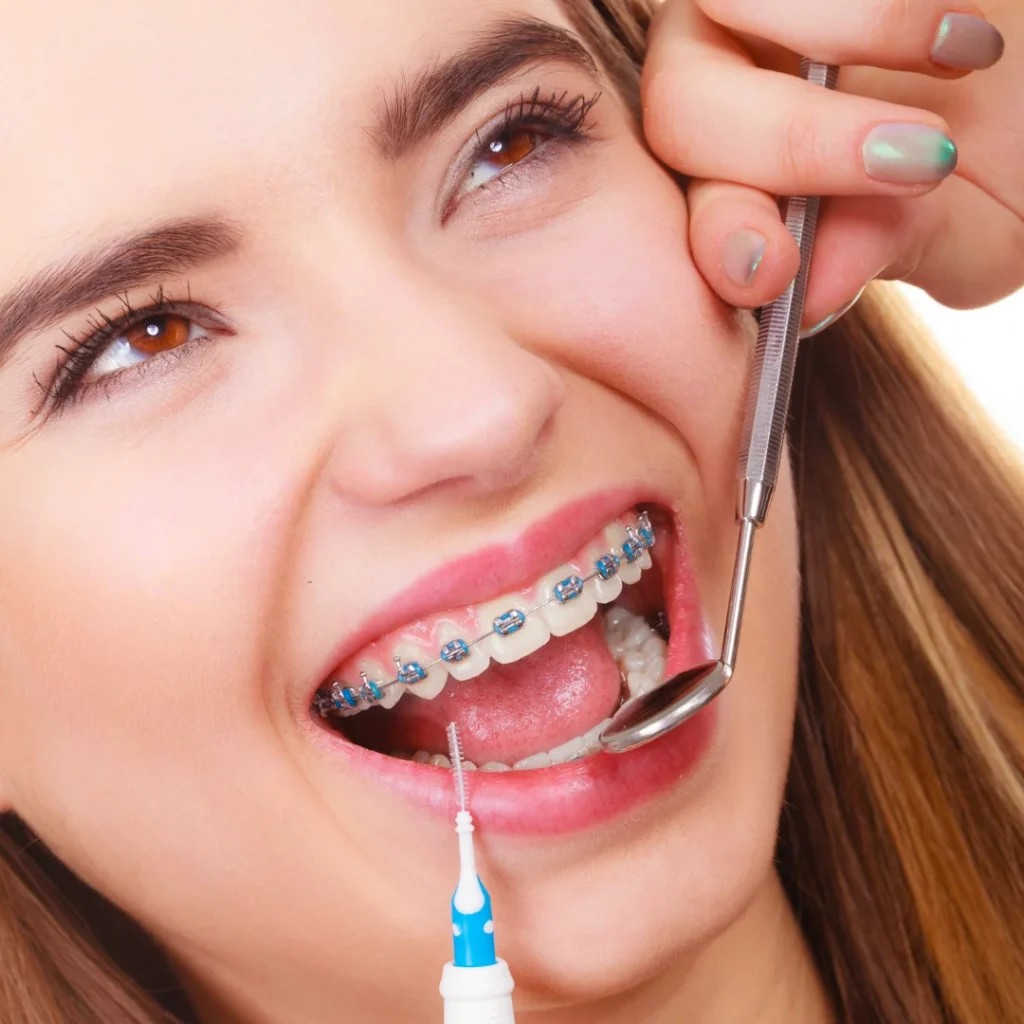 Color braces for teeth at lach orthodontic specialists (5)