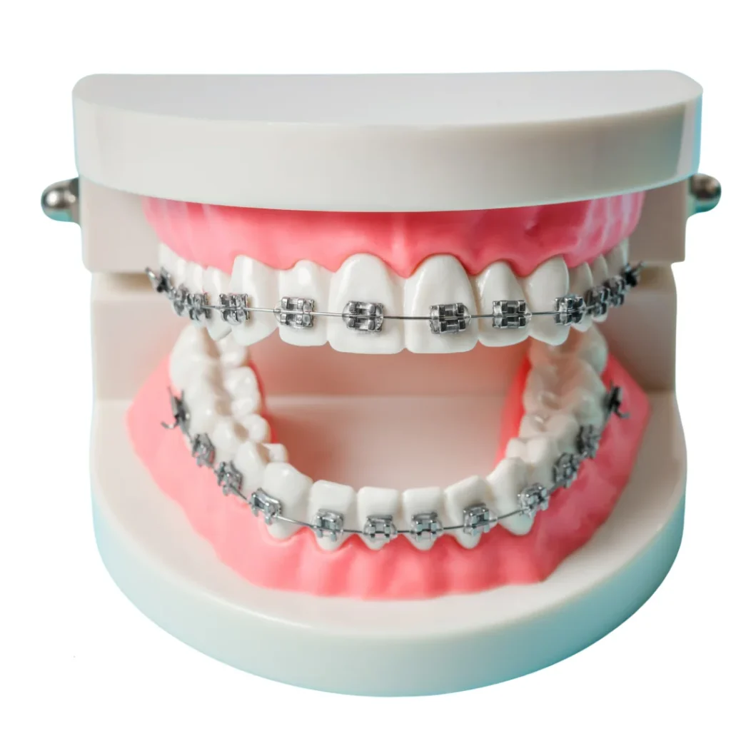 Clear braces vs metal