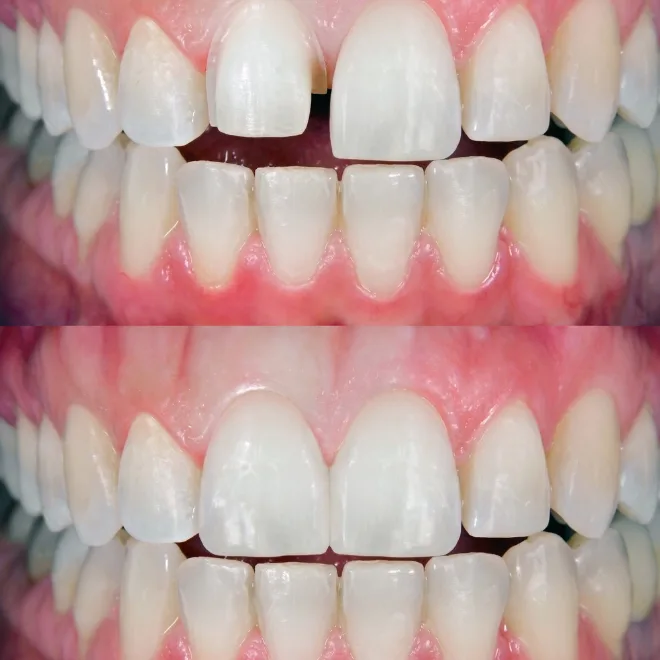 Dental veneers