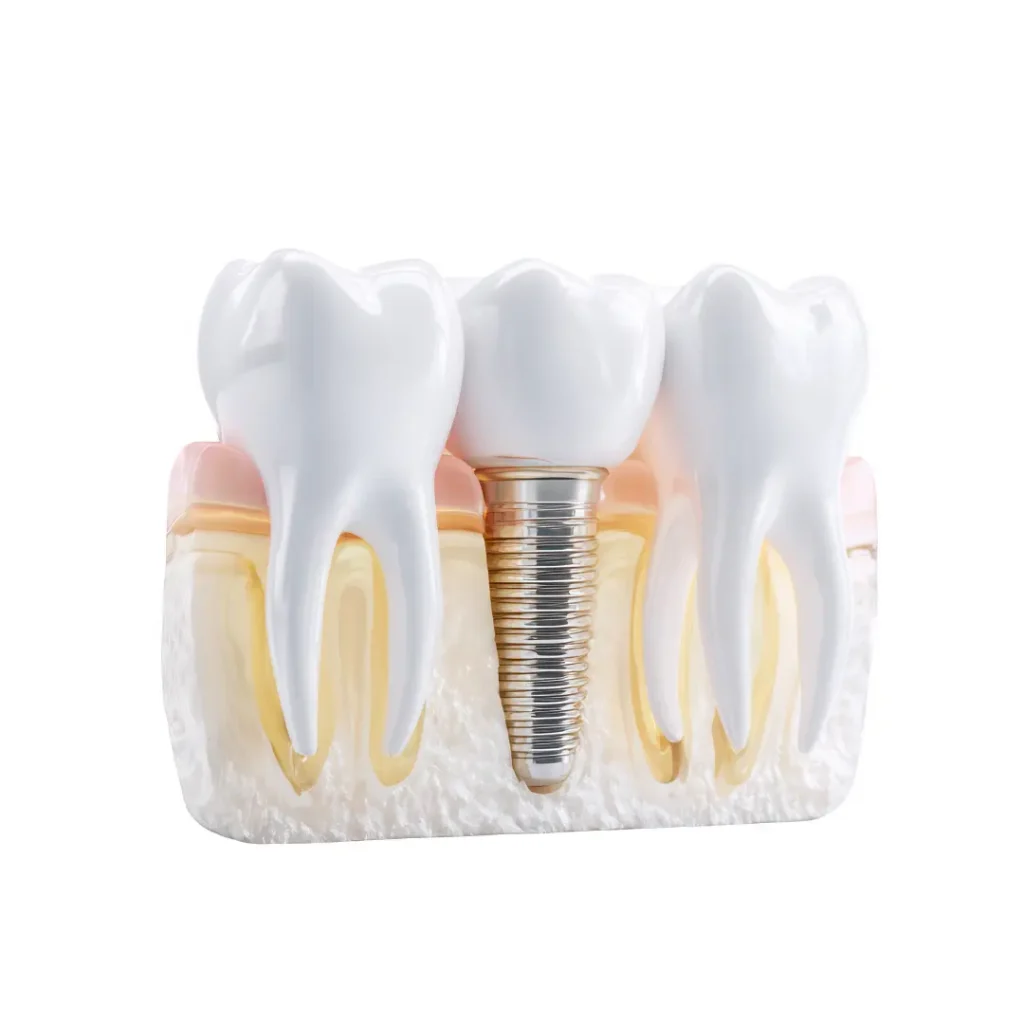 Affordable dental implants