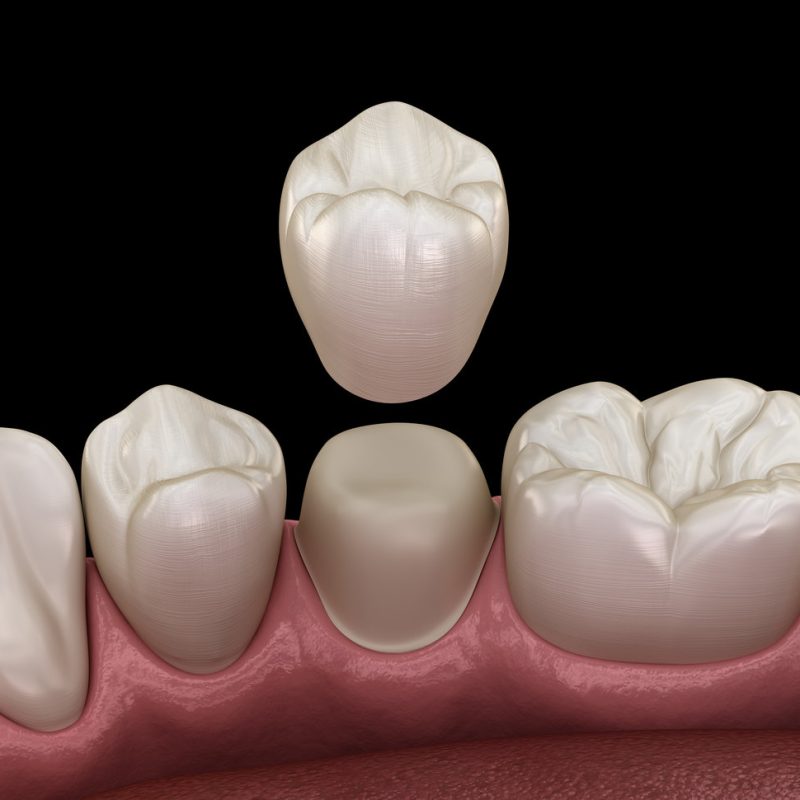 Dental crown premolar tooth assembly process. Medically accurate 3d illustration of human teeth treatment