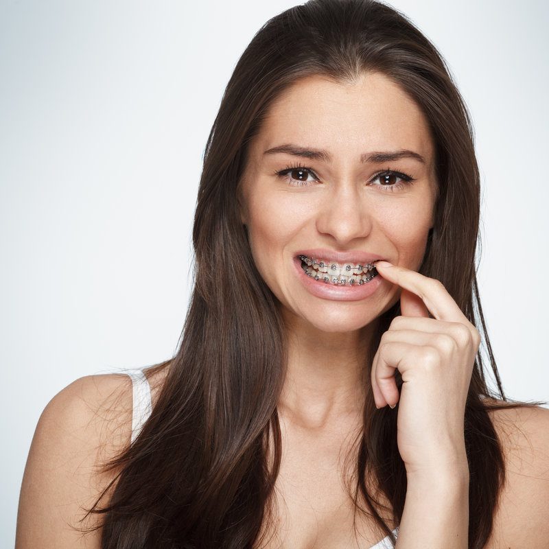 Face of a young woman with braces on her teeth