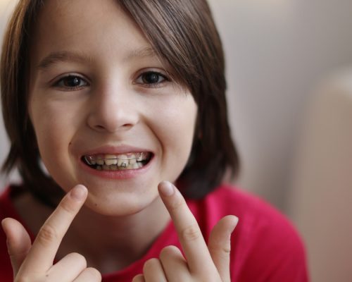 Braces for teens