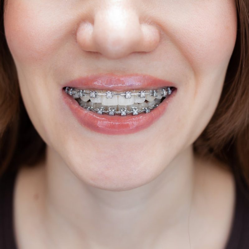The smile of a young and beautiful girl with braces on her white teeth. Straightening of crooked teeth with the help of a bracket system.